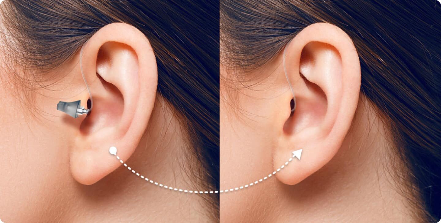 Nahezu Unsichtbare Hörgeräte