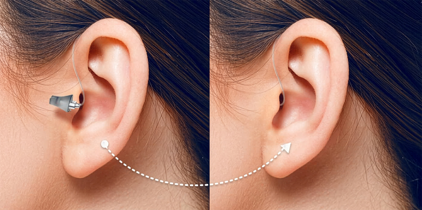 Unsichtbare Hörgeräte Unsichtbare Hörgeräte